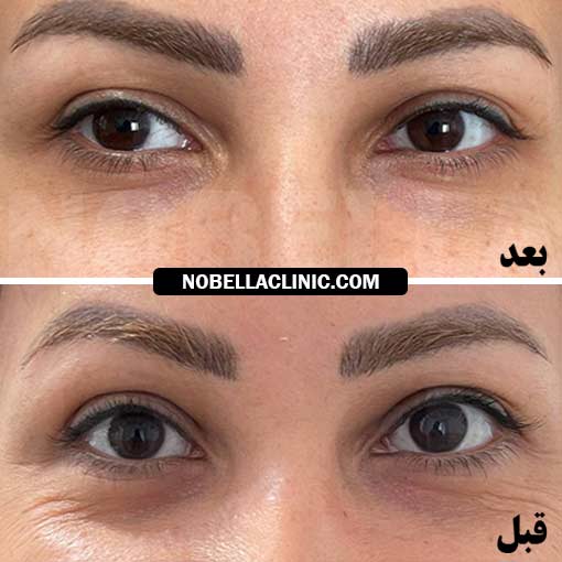 پی آر پی صورت