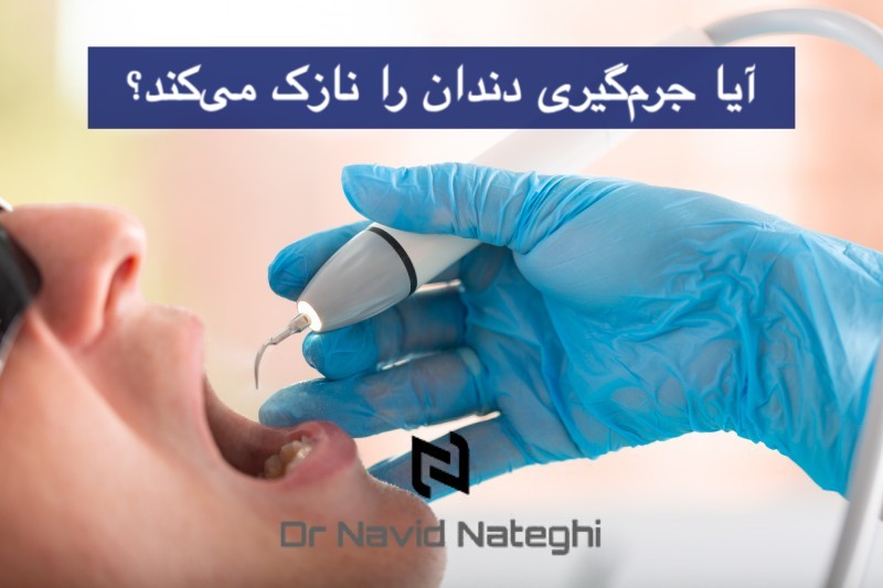 آیا جرم‌گیری دندان را نازک می‌کند؟ شفاف‌ سازی یک باور غلط رایج!
