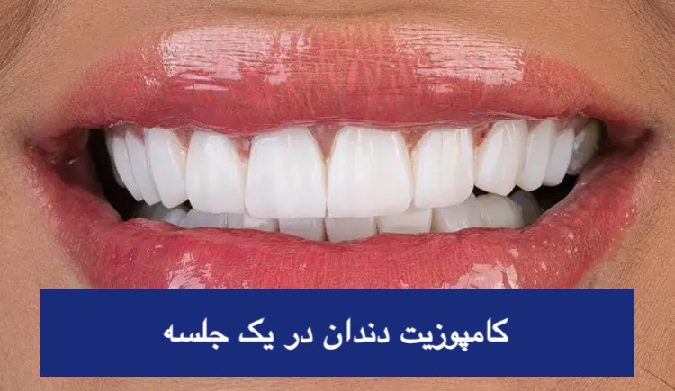 آیا کامپوزیت دندان یک جلسه‌ای ممکن است؟ راهنمای کامل زمان + قیمت ۱۴۰۴